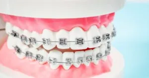 Traditional Metal Braces