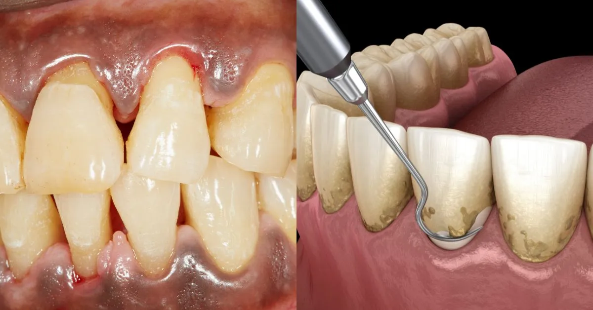 The Impact of Teeth Scaling and Polishing on Overall Health