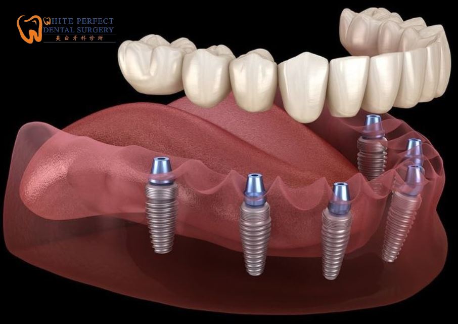 implant tooth cost in malaysia