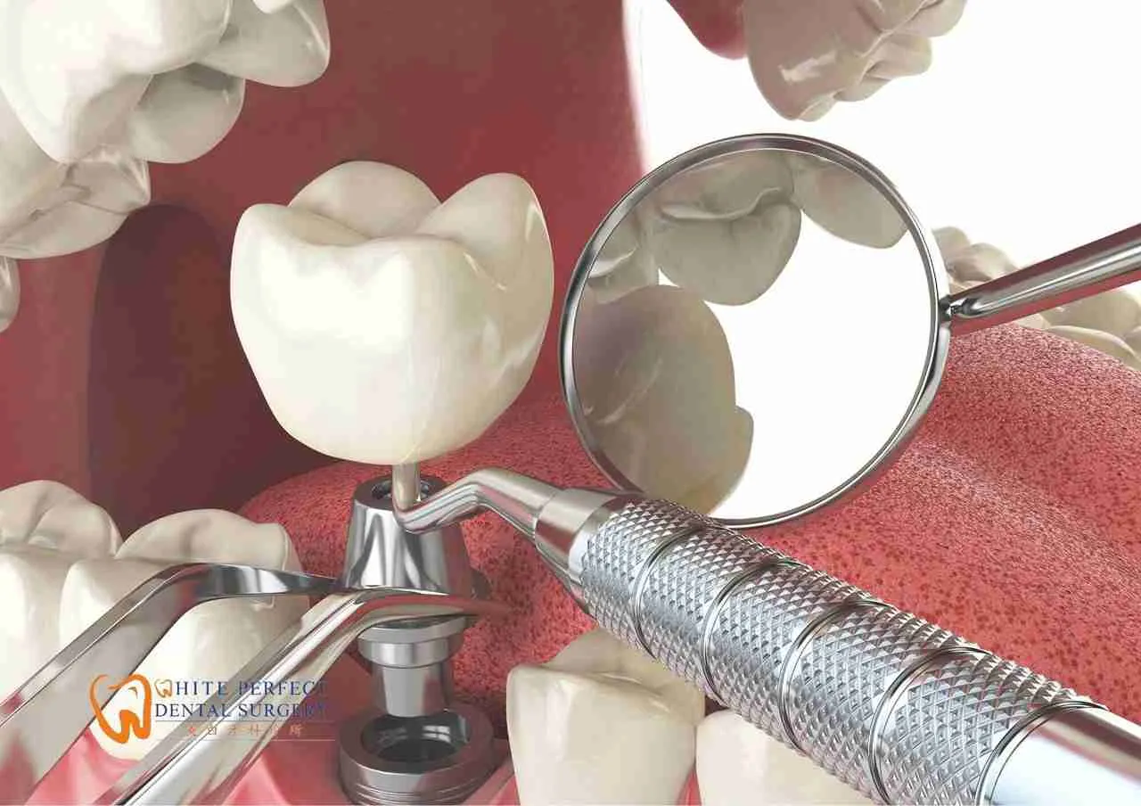 implant tooth cost in malaysia